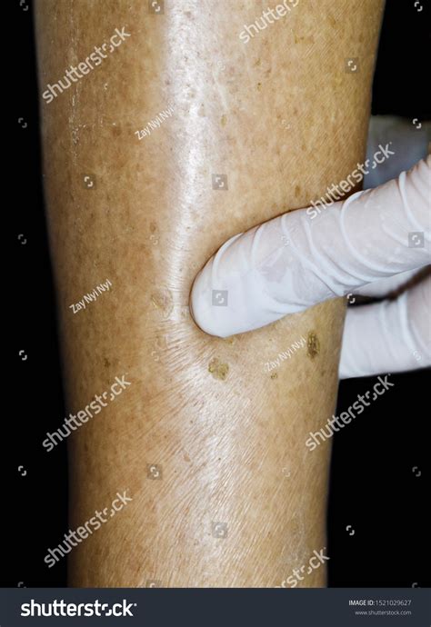 Doctor Testing Pitting Oedema Leg Patient Foto Stok 1521029627