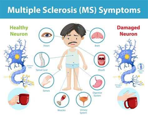 Unveiling Multiple Sclerosis Ms Cura4u