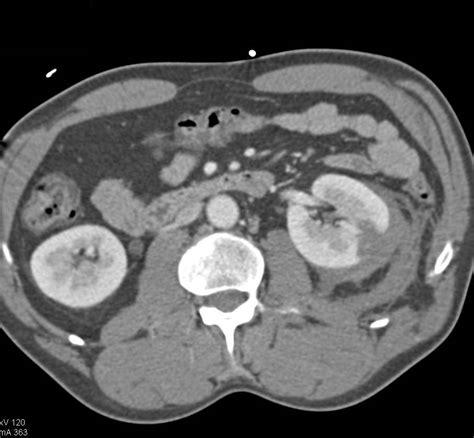 Renal Laceration Without Colon Injury Trauma Case Studies Ctisus Ct