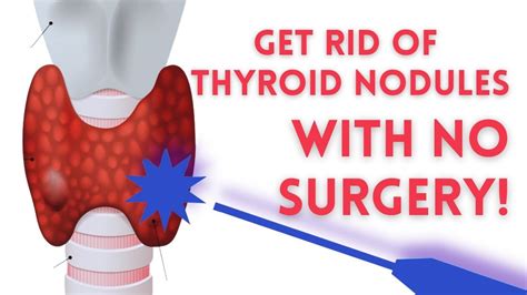 Radiofrequency Ablation RFA For Thyroid Nodules Dr Babak Larian