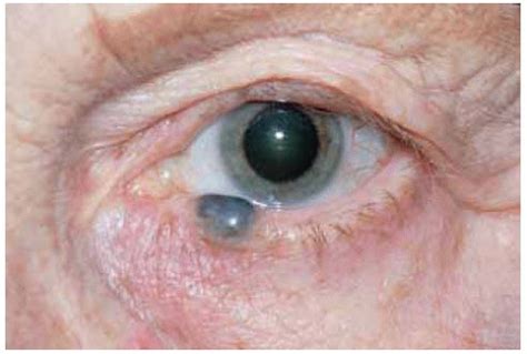 Eyelid Cystic Lesions Simulating Neoplasms | Ento Key