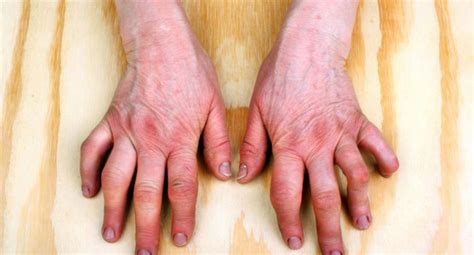 Do You Have Psoriatic Arthritis Symptoms