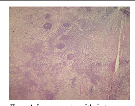 Figure 1 From Extra Nodal Rosai Dorfman Disease Of Nasal Septal Mucosa