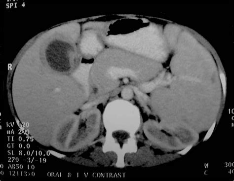 Tuberculosis Of The Gall Bladder A Case Report Eurorad