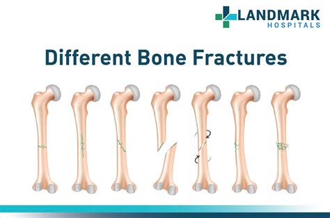 Visual Types Of Bone Fractures Guide Infographic Tv N