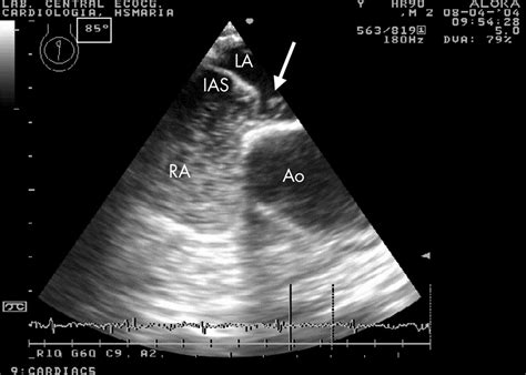 When And How To Diagnose Patent Foramen Ovale Heart