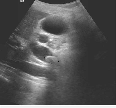 Ultrasound Showing Significant Proximal Common Bile Duct Dilatation