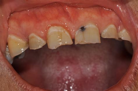 Gallery Dental Caries And Pulpitis Toothache Teeth Relief