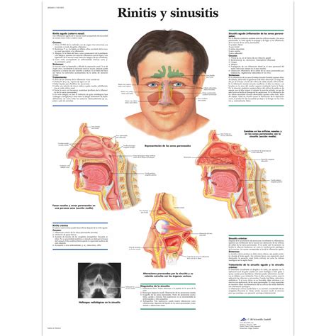 Rinitis Y Sinusitis 1001833 3b Scientific Vr3251l Ear Nose And