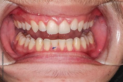 Frontal View Of A Unrecognisable Young Dentistry Case Man Open Mouth With A Trace A On The Lower