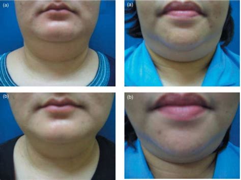 What Is High Submental Fat Double Chin Qoves