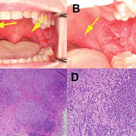 Ab Areas Of Mildly Erythematous Mucosa And Multiple Aphthous Ulcers