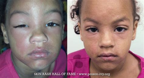 Little Girl With Poison Ivy Rash Poison