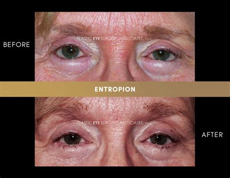 Ectropion Entropion Photos Plastic Eye Surgery Associates