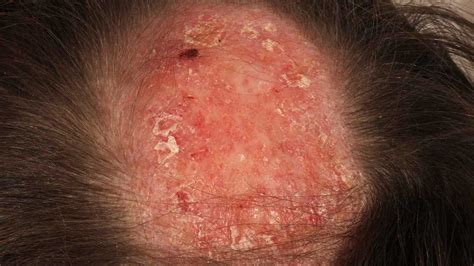 Lupus Hair Loss Pictures Symptoms Treatment Prevention And More
