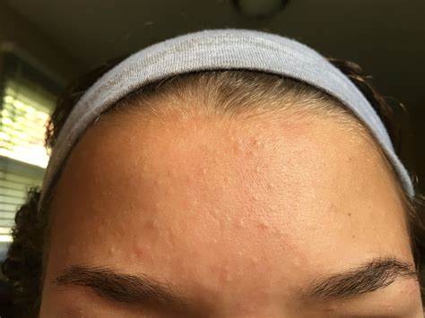 Small And Colorless Spots All Over Forehead Visible Pores And No Whiteheads General Acne