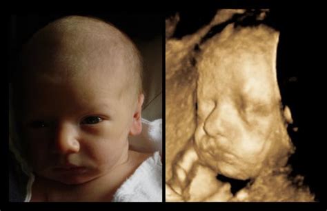 We offer elective 2d/3d/4d/hd ultrasounds to expectant mothers 15 weeks and on. 3d Scanner Image: 3d Sonogram