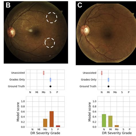 Example Cases In Which Model Grades Improved Diabetic Retinopathy Dr