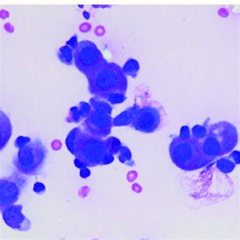Cytological Examination Of The Pleural Fluid Showing Clusters Of
