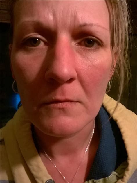 Lupus Rash Can Anyone Tell Me If They Also Lupus Uk