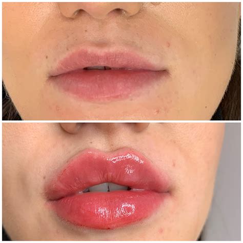 Russian Lips Vs Classic Lips