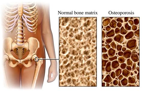 Osteoporosis Specialist 🩺singapore Sports And Orthopaedic Surgeon