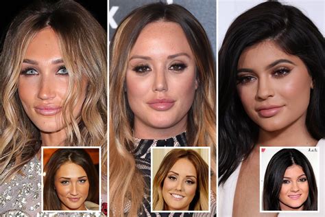 Botched Lip Fillers Warning As Expert Says Celebrities Fuel Rise In Cosmetic Procedures