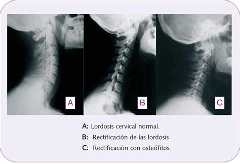 Las personas que sufren rectificación cervical, suelen sufrir con bastante frecuencia dolores de región cervical (7 vértebras, de la c1 a la c7), cuya curvatura es convexa y se denomina lordosis. Dolor de espalda | Farmacia Profesional