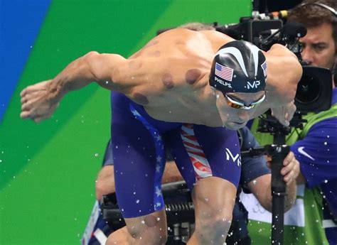 How To Get Rid Of Cupping Marks Faster Faisalneema