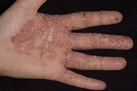 Dry Eczema On Hands Pictures 475 Photos And Images