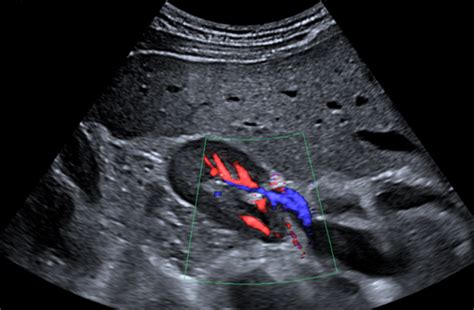 Renal Ultrasound Insight Medical Imaging