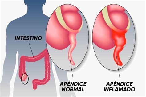 Síntomas de la apendicitis y cómo tratar