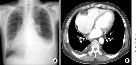 Figure 1 From Intrapleural Corticosteroid Injection In Eosinophilic