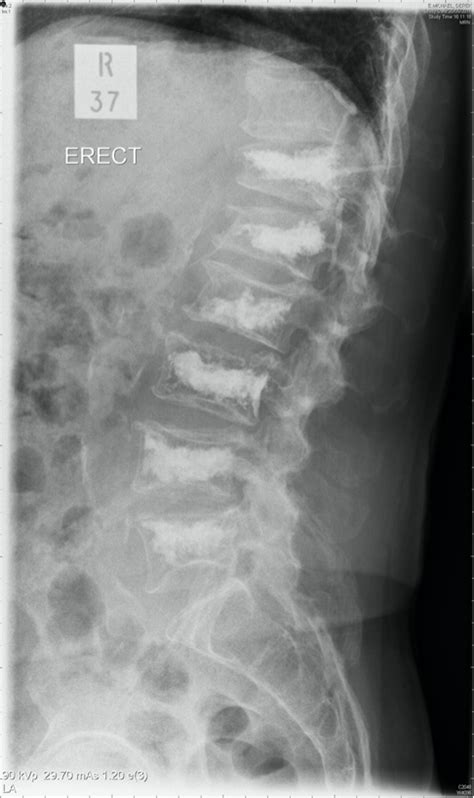 Cheltenham Spine Clinic Osteoporotic Vertebral Compression Fractures