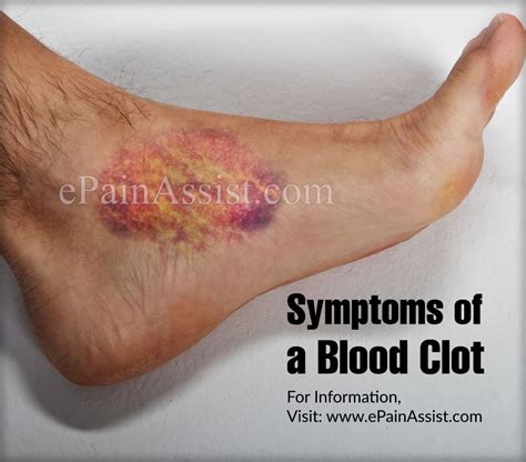 Blood Clot Symptoms To Watch Out For