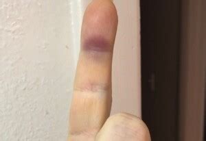 Sudden Purple Bruise On Underside Of Index Finger Scary Symptoms
