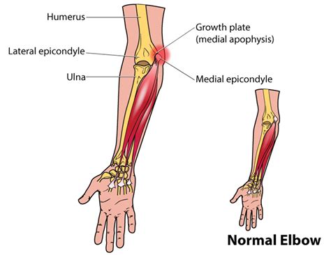 Little Leaguers Elbow Symptoms Treatment Surgery And Pitch Counts
