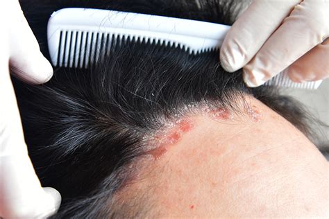 Hair Loss And Scalp Issues Causes And Treatment Healthsprings