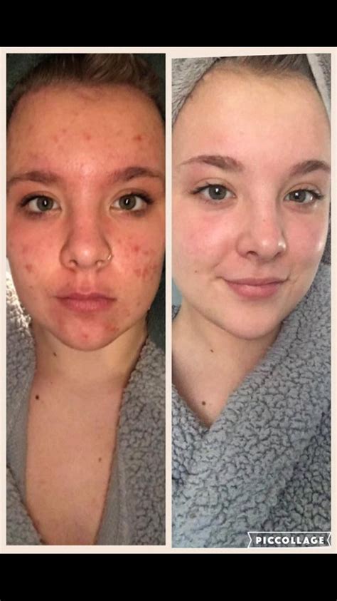 How Long Does Accutane Take To Work Rectangle Circle