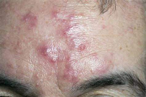 Acne Rosacea On The Forehead Stock Image C0111707 Science Photo