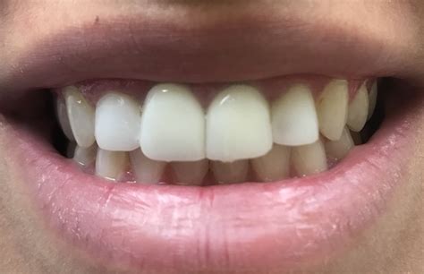 Porcelain Veneer Photos Nanuet Ny Hasbrouck Heights Nj Before And After