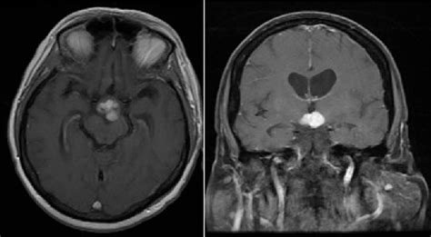 Figure 1 From A Singular Case Of Intracranial Sinus Histiocytosis