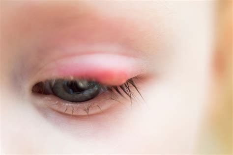 Staph Infection In Toddlers Signs Prevention And Treatments