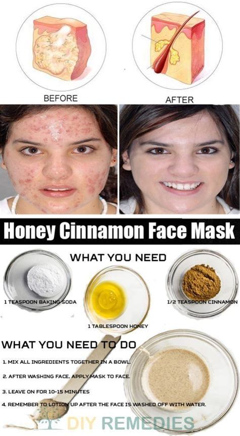 Honey And Cinnamon Face Mask For Acne By Ruby