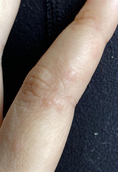 Weird Bumps On Finger Rpsoriasis