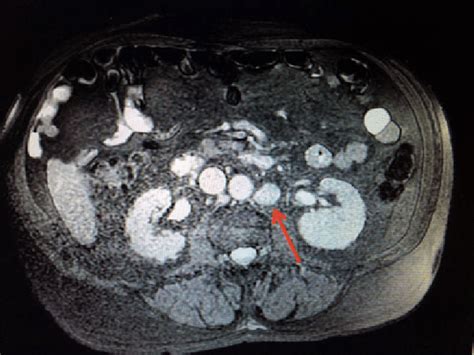 Mri Of The Abdomen Demonstrates An Enlarged 20 Cm Left Para Aortic