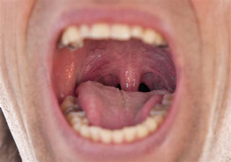 Throat Uvula Surgery
