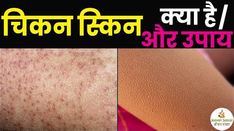चिकन स्किन की परेशानी कैसे दूर करे Chicken Skin Treatment In Hindi