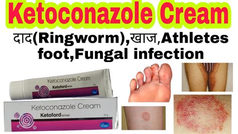 Ketoconazole Cream Ketoconazole Cream Uses In Hindi Dad Khaj