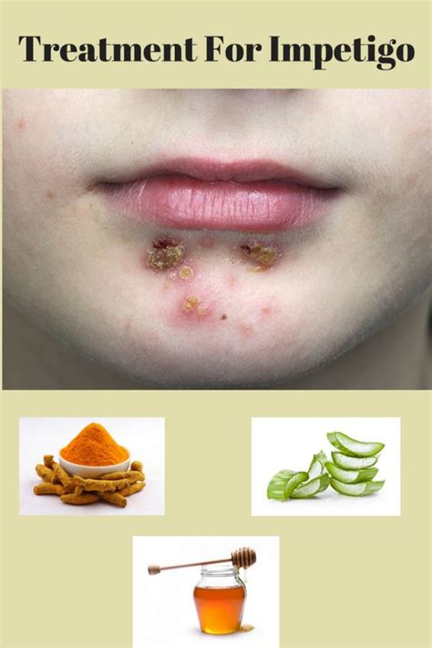 What Is Impetigo How To Deal With It